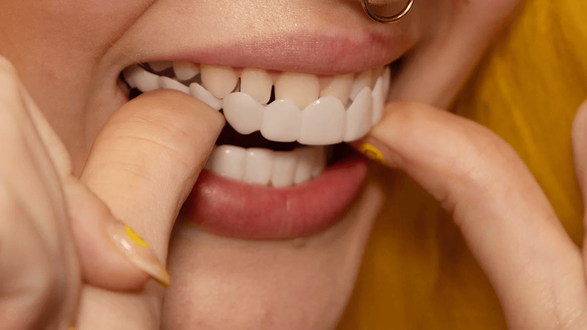 Snap on Smile Veneers (Övre & Nedre)