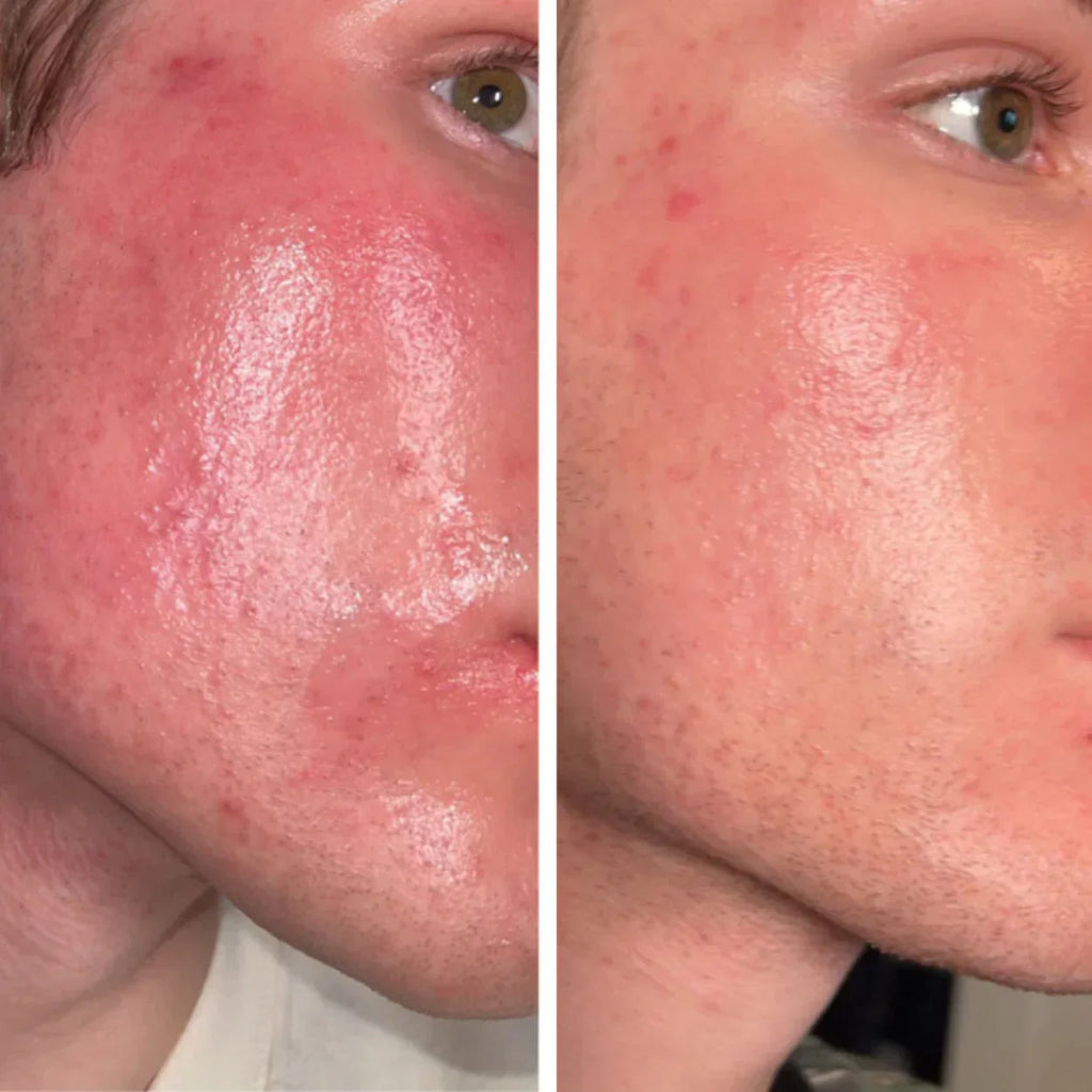 Vrimlo LED | Thérapie par lumière rouge | Masque facial | Masque infrarouge flexible !