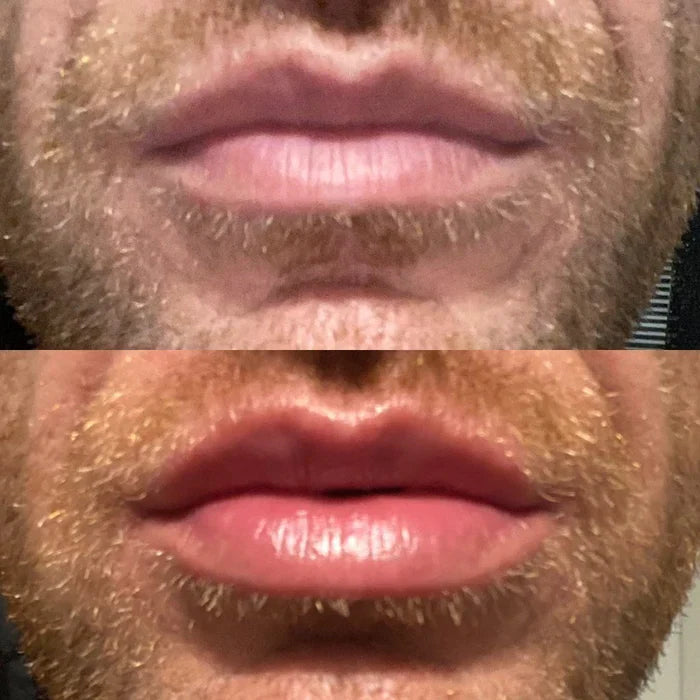 סרום מיידי למילוי שפתיים