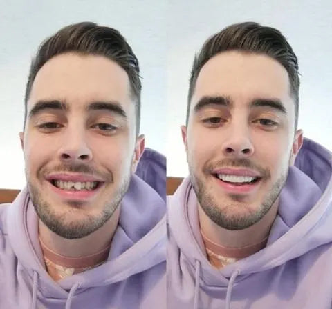 BrightSmile Veneers Set mit Ober- und Unterkiefer inklusive