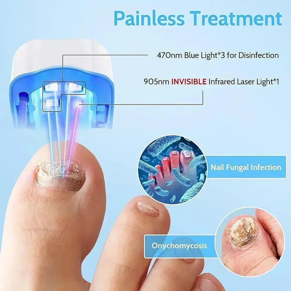 Appareil Laser de Nettoyage contre le Champignon des Ongles - Dispositif Révolutionnaire Expert de Thérapie par Lumière à Haute Efficacité pour les Maladies des Ongles des Pieds