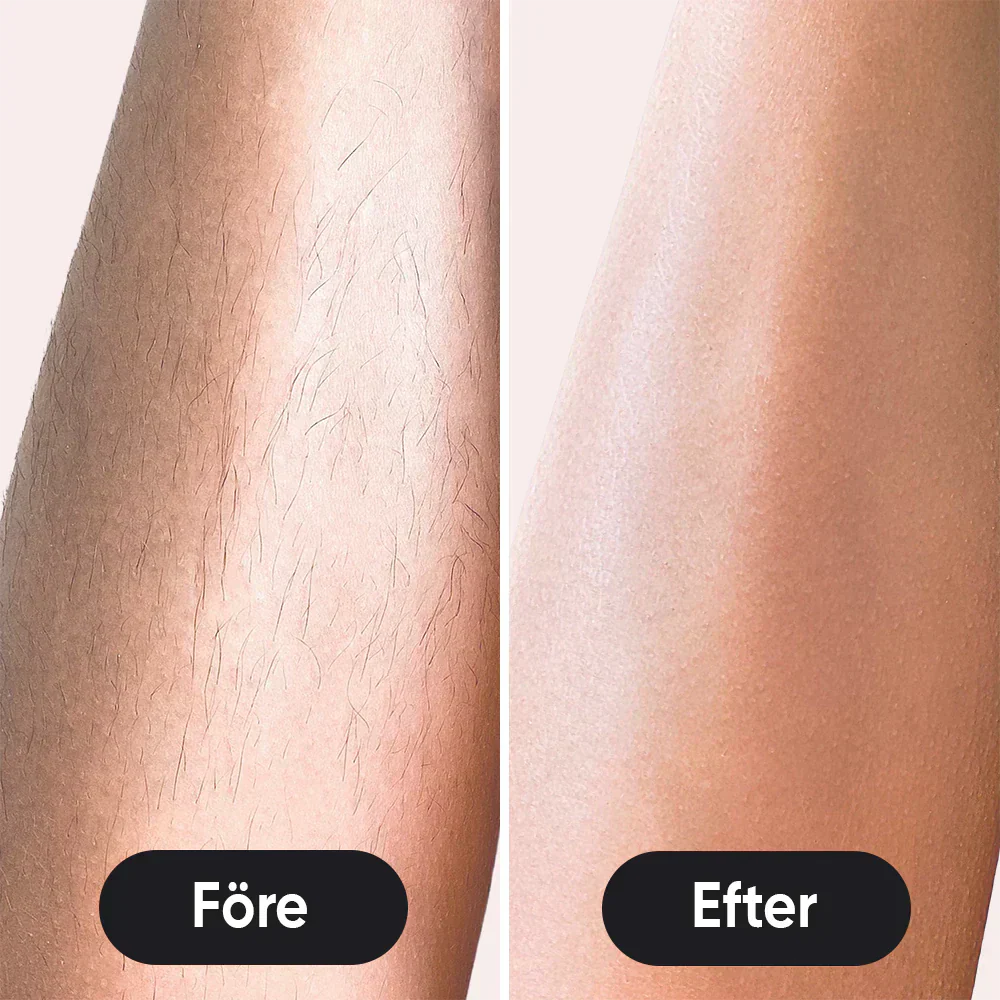 IPL - trajno uklanjanje dlaka