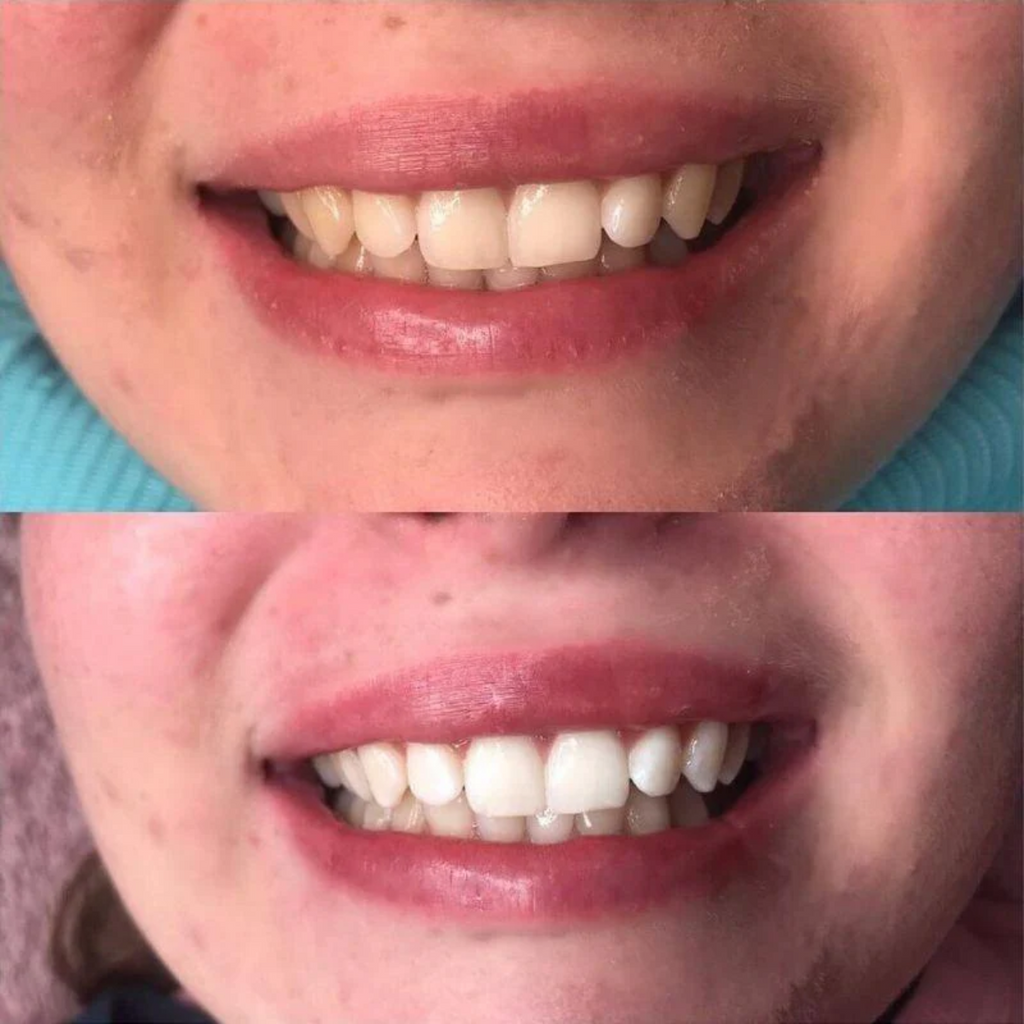 SmileKit | Denti bianchi, gengive sane e alito fresco