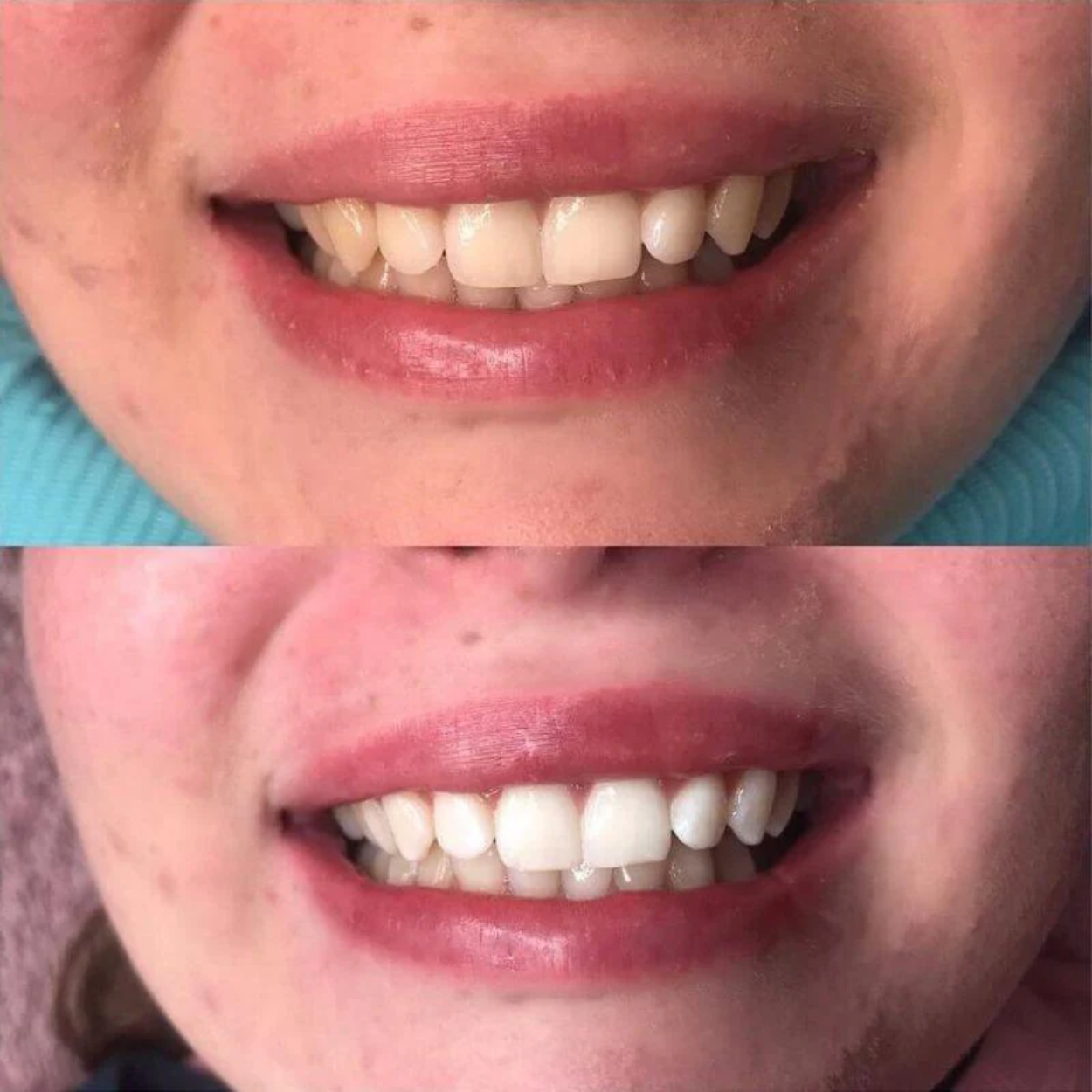 SmileKit | Denti bianchi, gengive sane e alito fresco