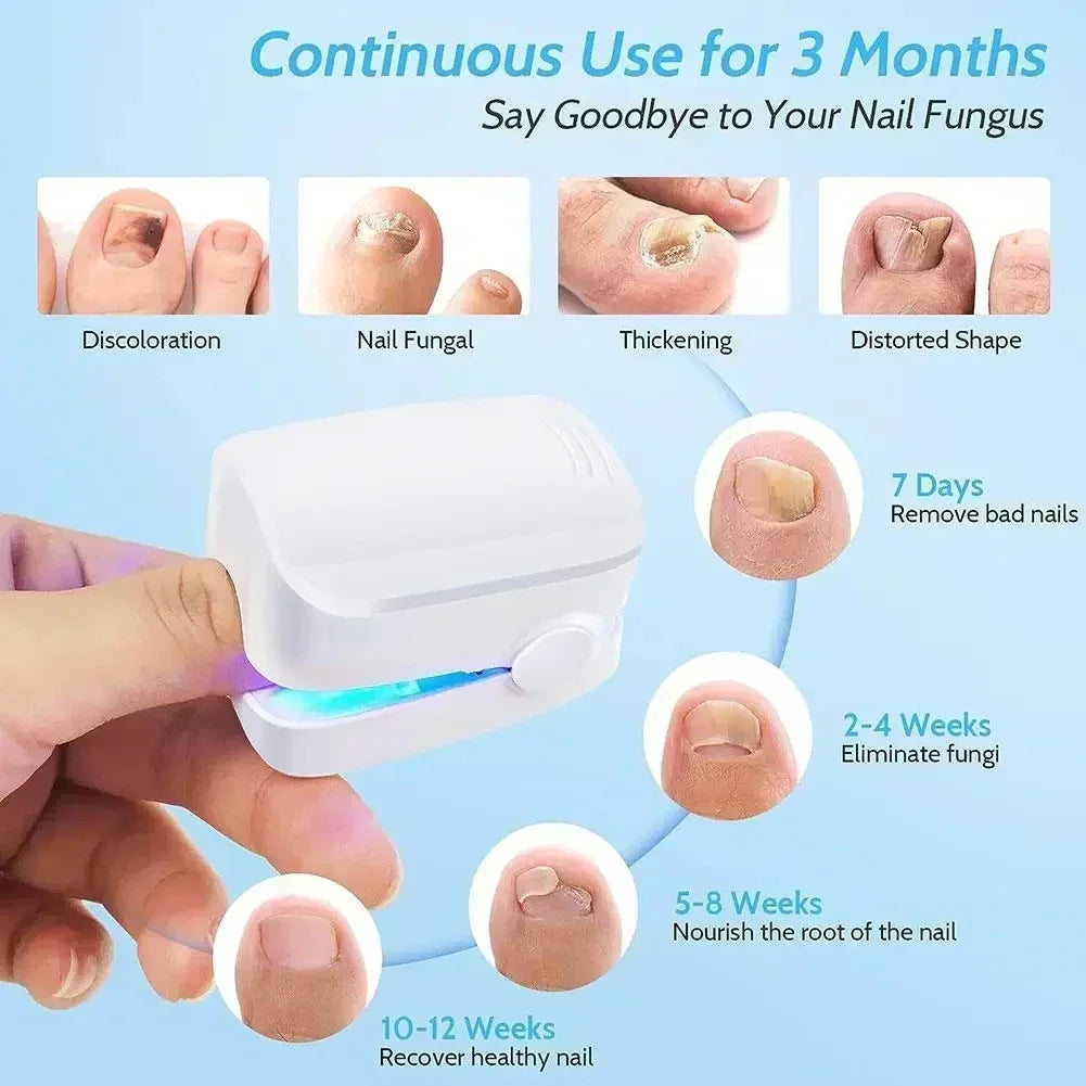 Appareil Laser de Nettoyage contre le Champignon des Ongles - Dispositif Révolutionnaire Expert de Thérapie par Lumière à Haute Efficacité pour les Maladies des Ongles des Pieds