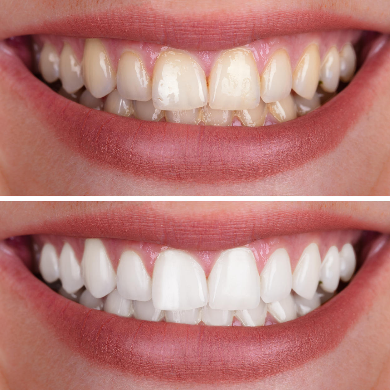 SmileKit | Denti bianchi, gengive sane e alito fresco