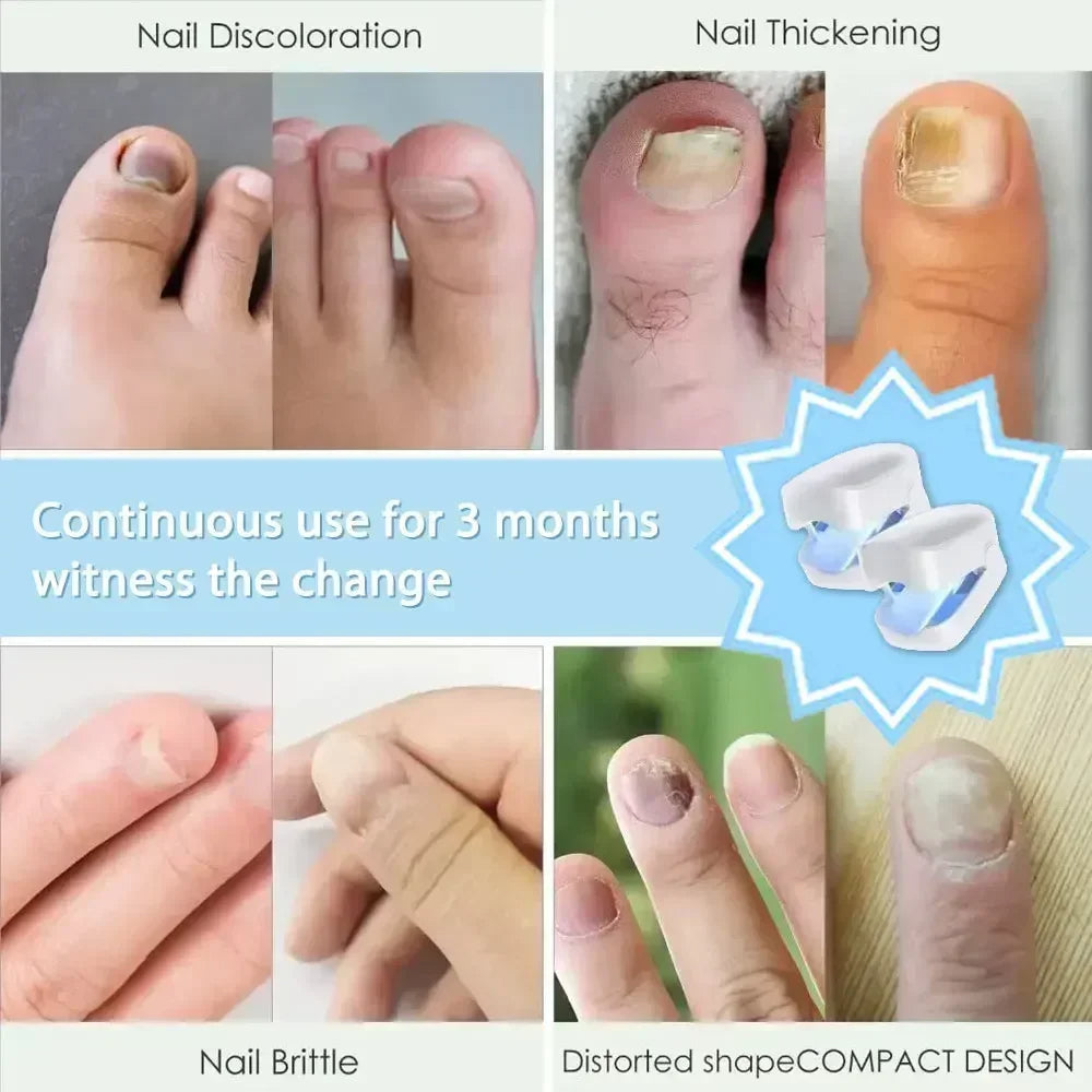 Appareil Laser de Nettoyage contre le Champignon des Ongles - Dispositif Révolutionnaire Expert de Thérapie par Lumière à Haute Efficacité pour les Maladies des Ongles des Pieds