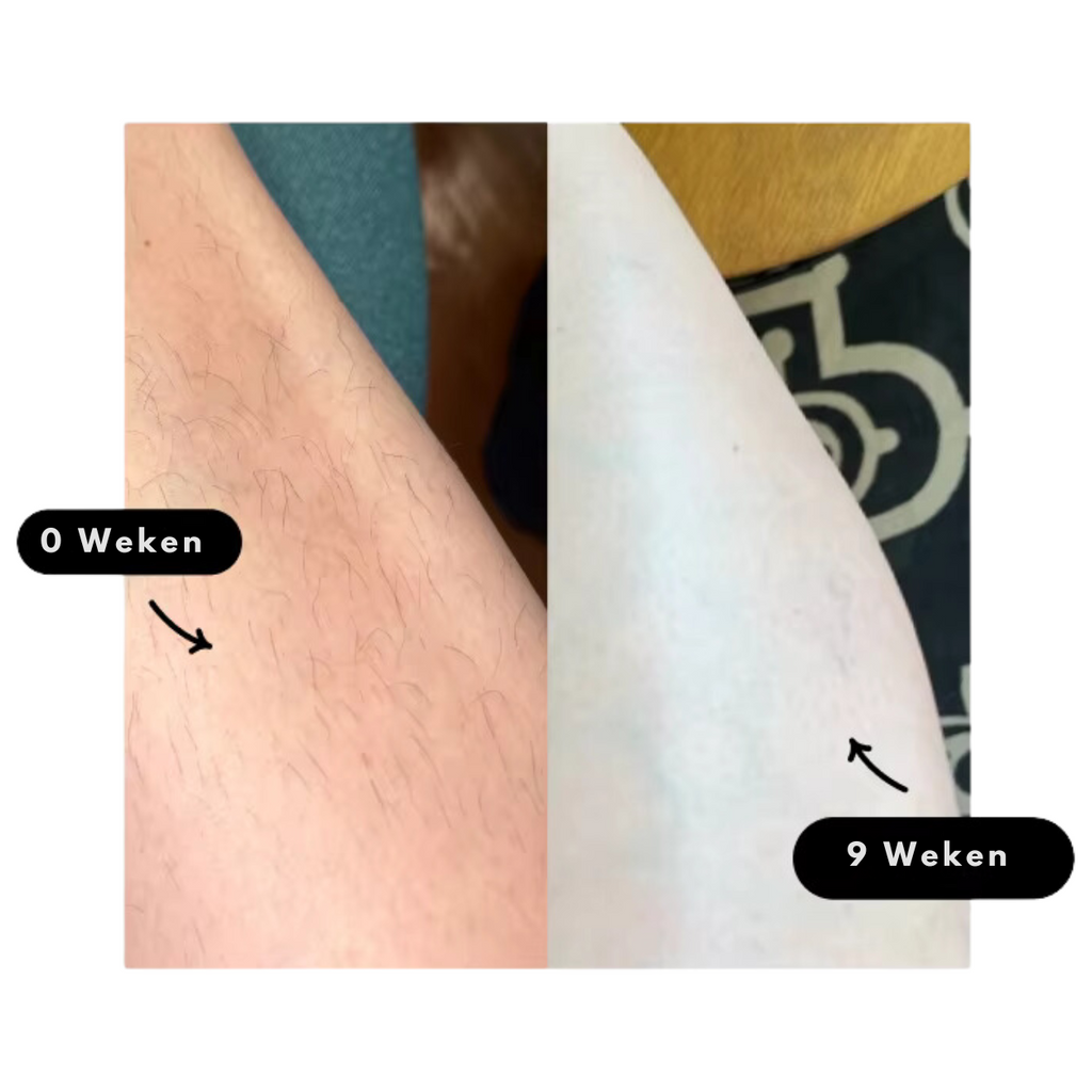 Glowfree | Karvattomampi iho helposti IPL-laserkarvanpoistajalla