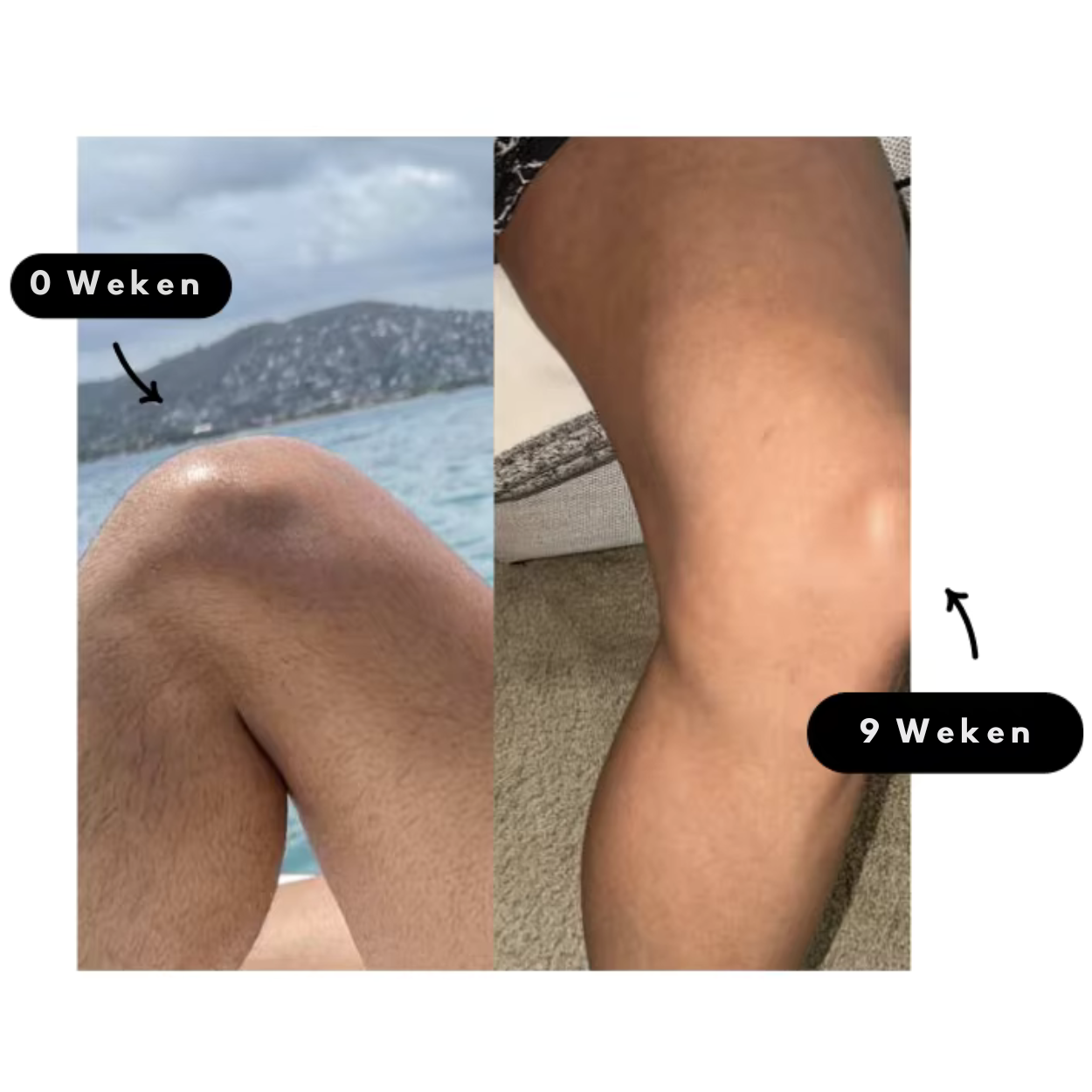Glowfree | Karvattomampi iho helposti IPL-laserkarvanpoistajalla