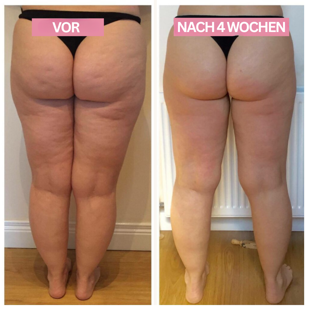 Appareil de Ventouses Anti-Cellulite LumaSculpt à Domicile pour une Peau Plus Lisse et Plus Ferme