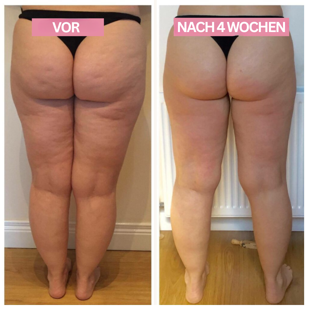 Appareil de Ventouses Anti-Cellulite LumaSculpt à Domicile pour une Peau Plus Lisse et Plus Ferme