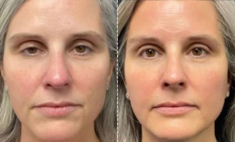 Masque de tonification et de lifting facial EMS