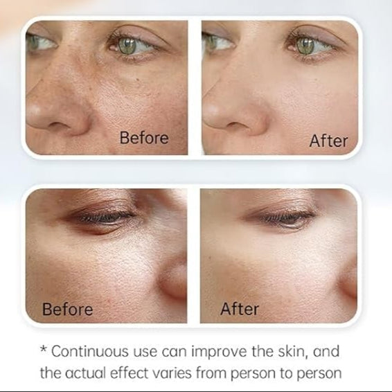 Advanced Lumina Pro Microneedling Pen For Facial Rejuvenation