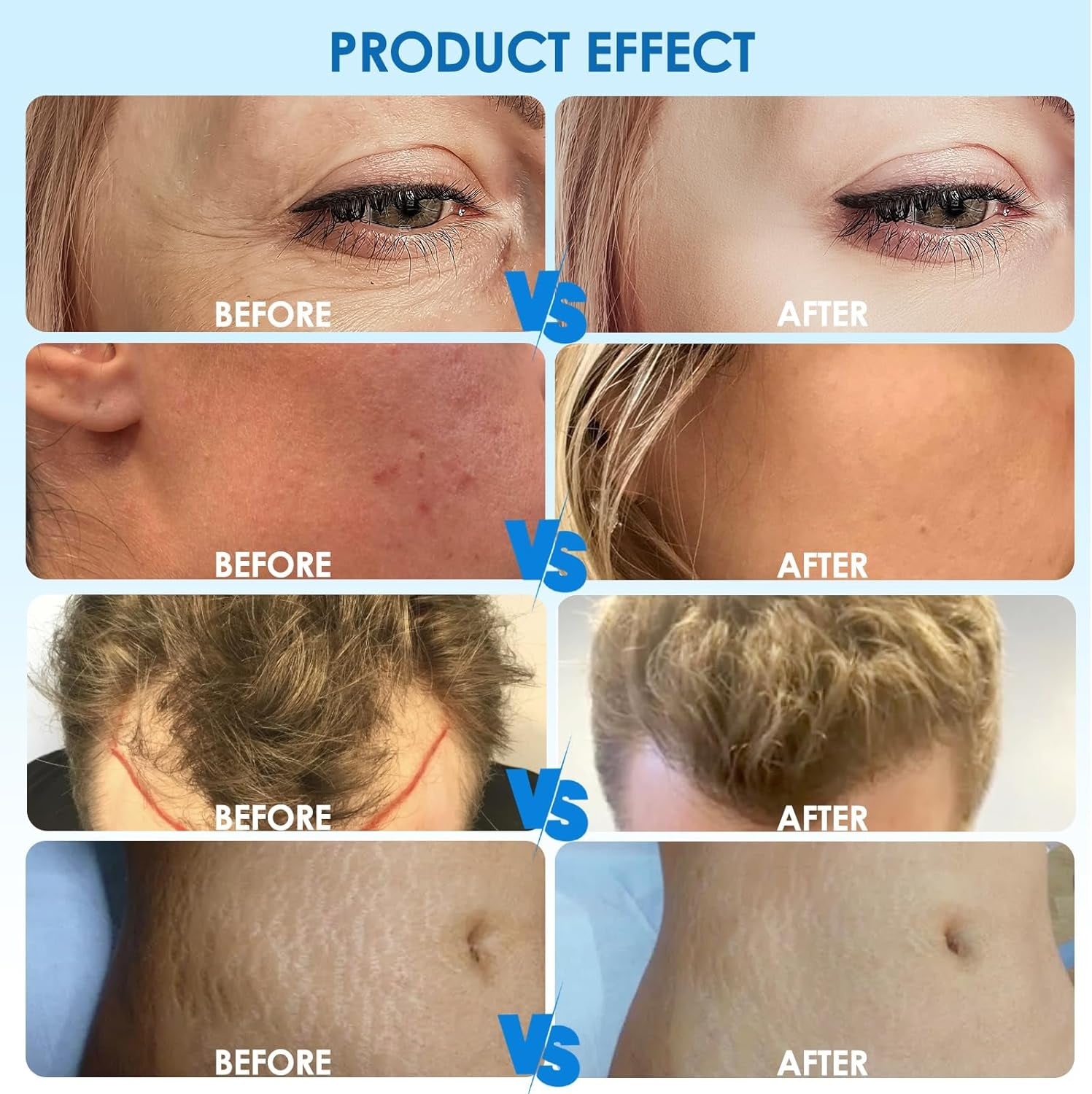 Advanced Lumina Pro Microneedling Pen For Facial Rejuvenation