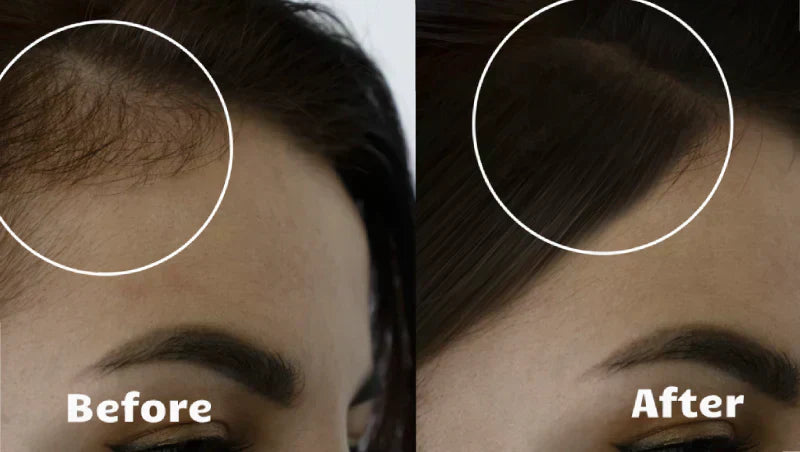 Thérapie lumineuse RadiantGlow pour des cheveux plus épais, plus fournis et plus sains en 10 minutes par jour
