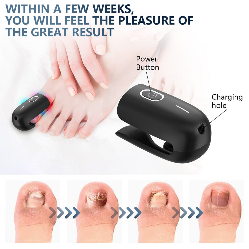 At Home Toenail Fungus Laser Therapy Device For Home Use