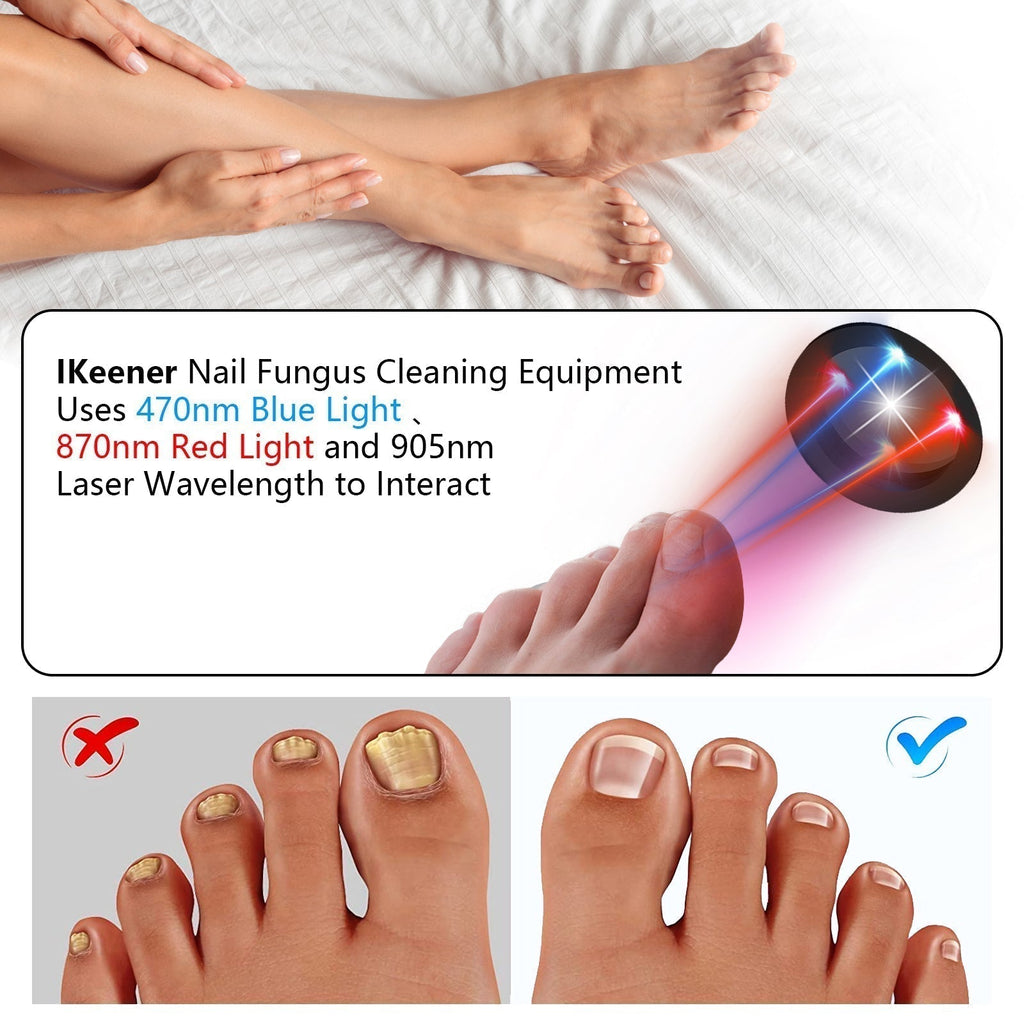 At Home Toenail Fungus Laser Therapy Device For Home Use