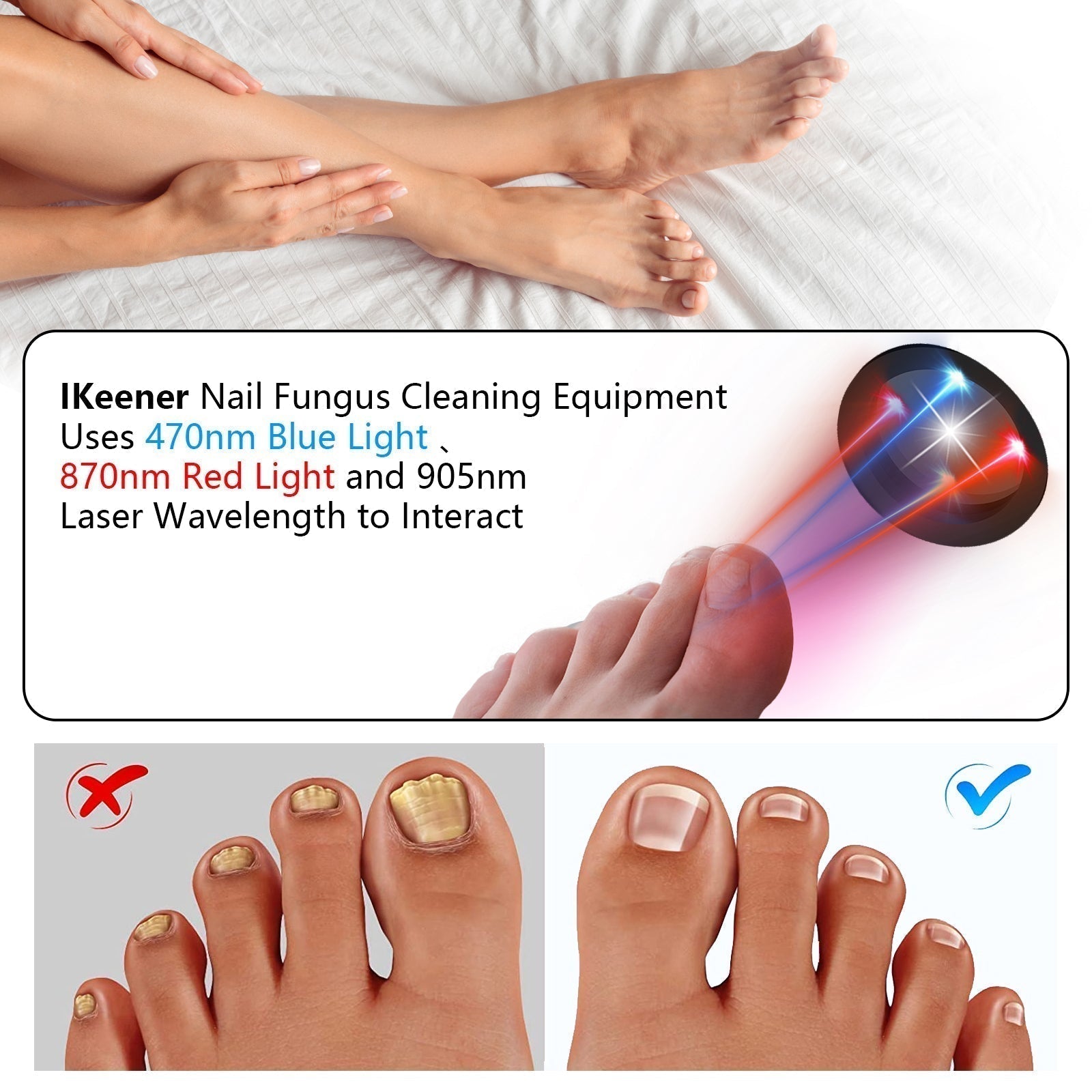 At Home Toenail Fungus Laser Therapy Device For Home Use
