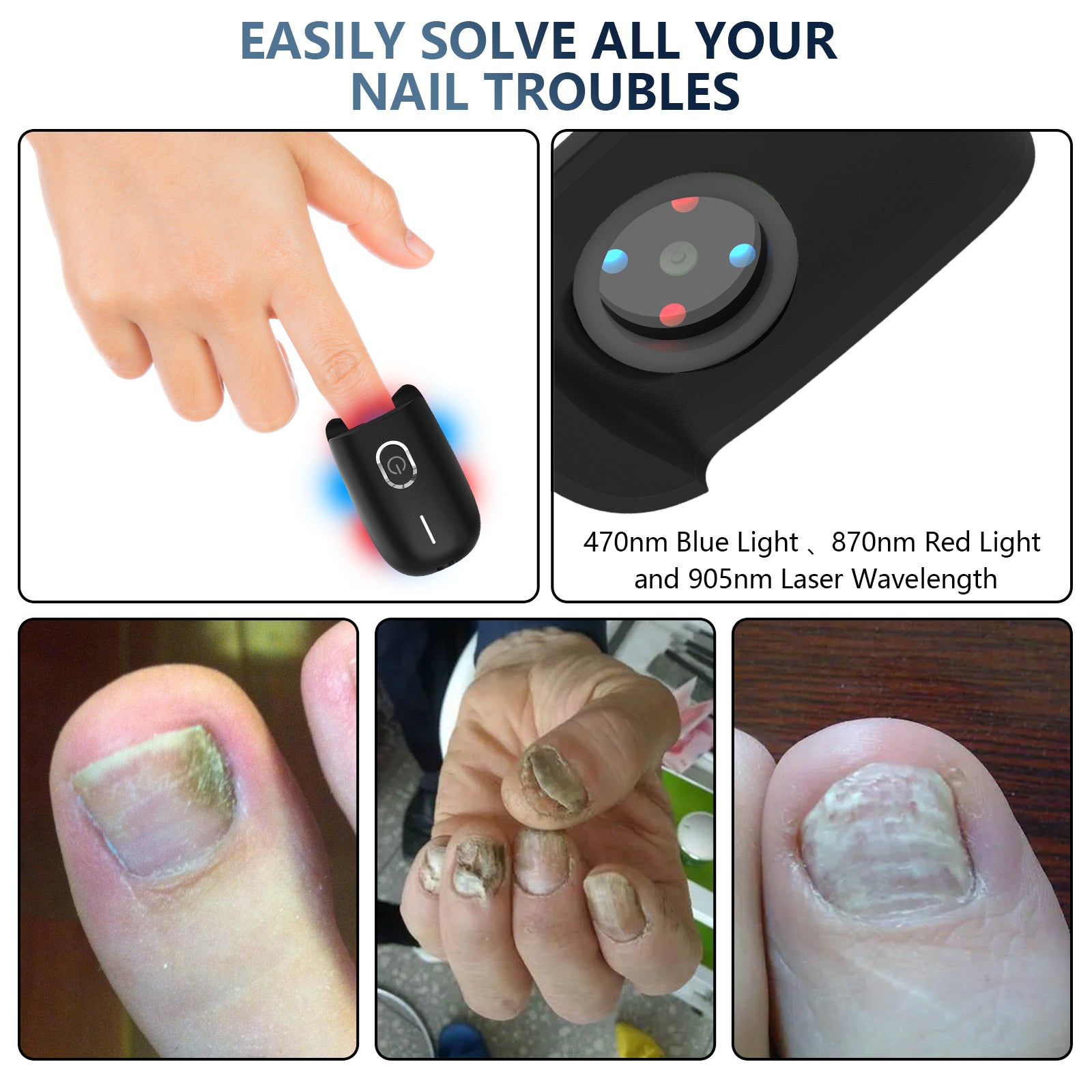 At Home Toenail Fungus Laser Therapy Device For Home Use