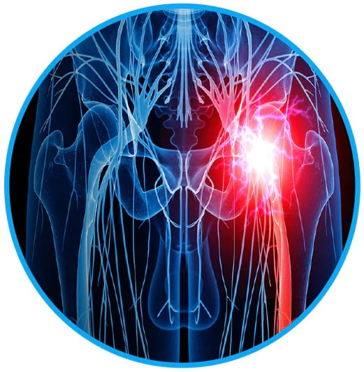 חגורת הקלה על כאבי סיאטיקה - סלק את כאבי הסיאטיקה וכאבי הגב התחתון שלך