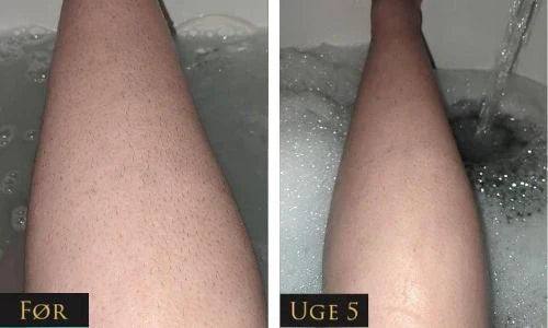 IPL - trajno uklanjanje dlaka