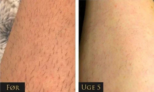 IPL - trajno uklanjanje dlaka