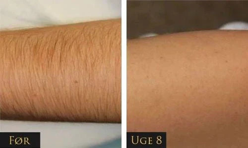 IPL - trajno uklanjanje dlaka