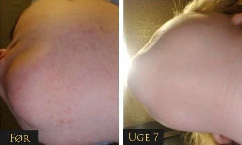 IPL - trajno uklanjanje dlaka