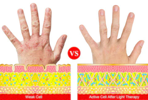 Gants de thérapie par lumière rouge pour l'arthrite, soulagement de la douleur du poignet et de la main, proche infrarouge
